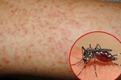 GÓC TUYÊN TRUYỀN: PHÒNG CHỐNG SỐT XUẤT HUYẾT, BỆNH CHÂN TAY MIỆNG